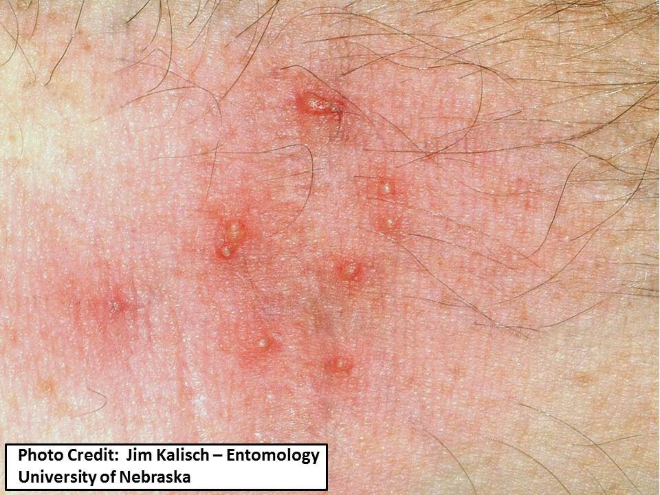 Oak Itch Mite Bites